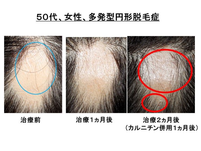 円形脱毛症　病院